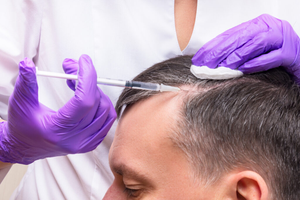 Male receiving PRP hair loss treatment