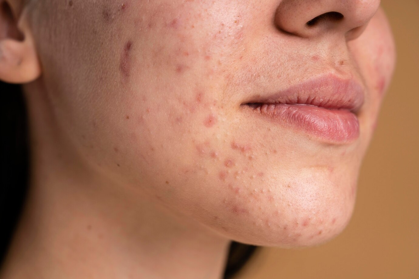 woman-with-acne
