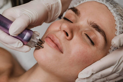 PRP Acne Treatment